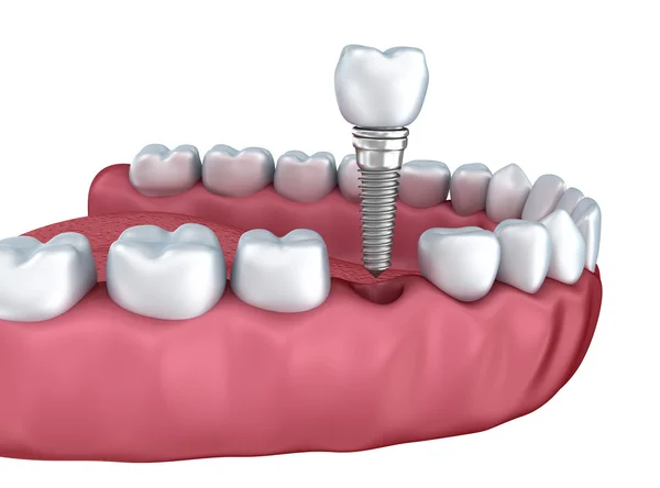 Vista de cerca de dientes inferiores e implantes dentales aislados en blanco Imagen de archivo