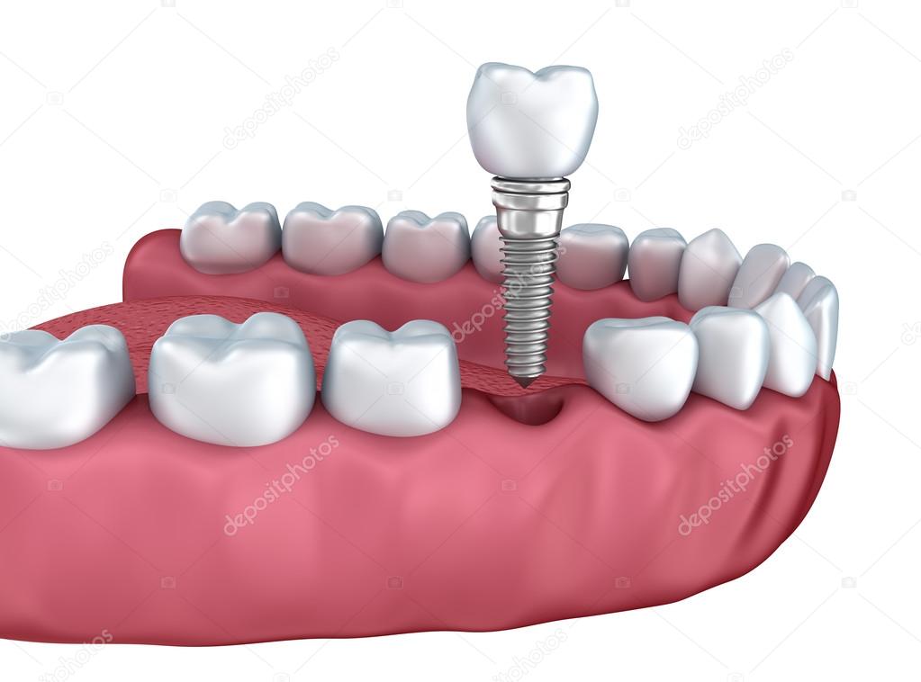 A close-up view of lower teeth and dental implants isolated on white