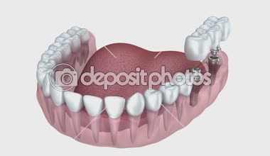alt dişler ve Diş implantları üzerine beyaz izole yakından görmek