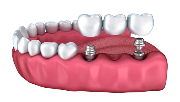 3d dientes inferiores e implante dental aislado en blanco — Foto de Stock