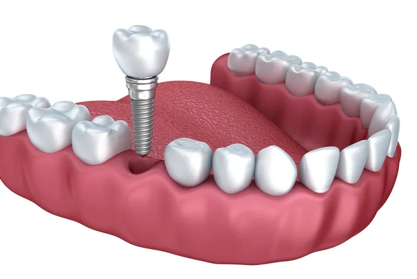 3d dientes inferiores e implante dental aislado en blanco — Foto de Stock