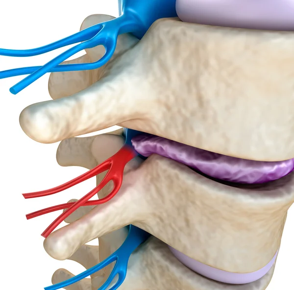 Spinal cord under pressure of bulging disc — Stock Image Spinal cord under pressure of bulging disc Stock Picture