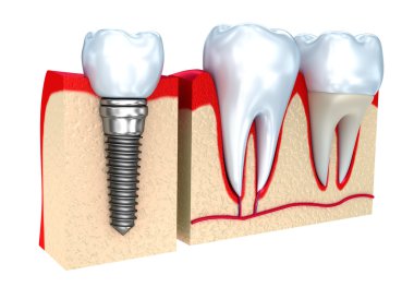 Diş tacı , implant ve dişler , 3d görüntü .