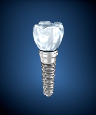 Diş titanyum implant