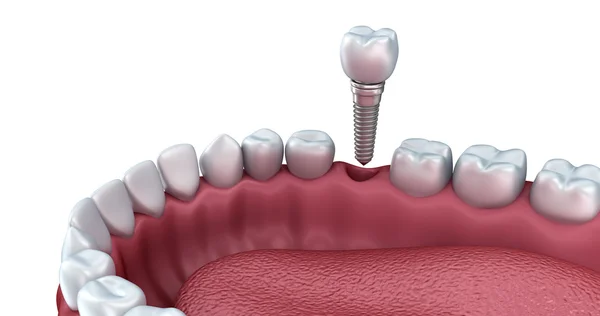 3D spodní zuby a zubní implantát izolované na bílém — Stock fotografie