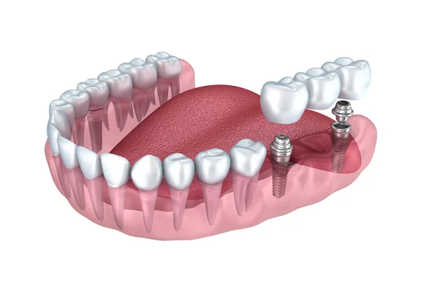 Diş titanyum implant — Stok fotoğraf