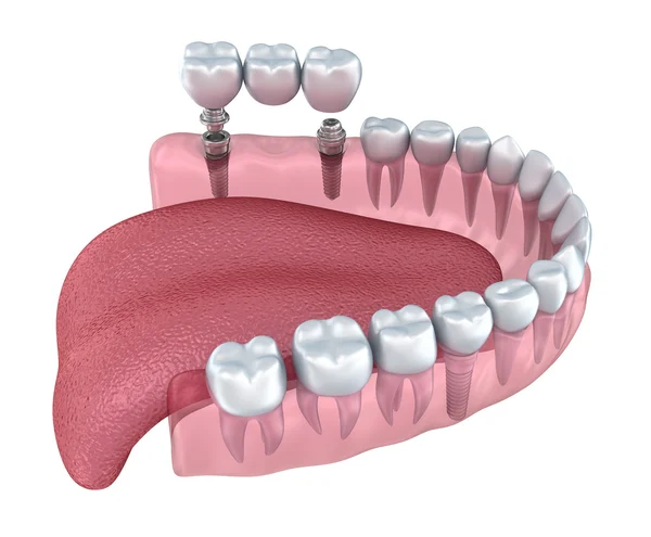 Titán fogászati implantátum — Stock Fotó