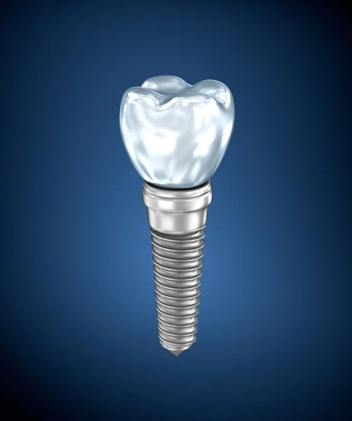 Implant dentystyczny tytanu — Zdjęcie stockowe