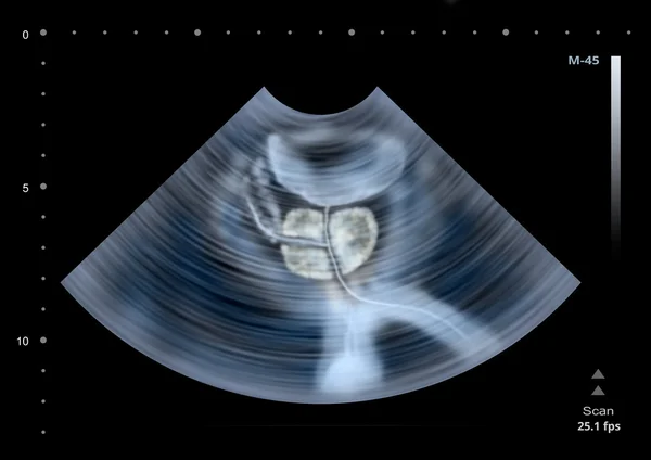 Scansione ecografica della prostata umana. Illustrazione — Foto Stock