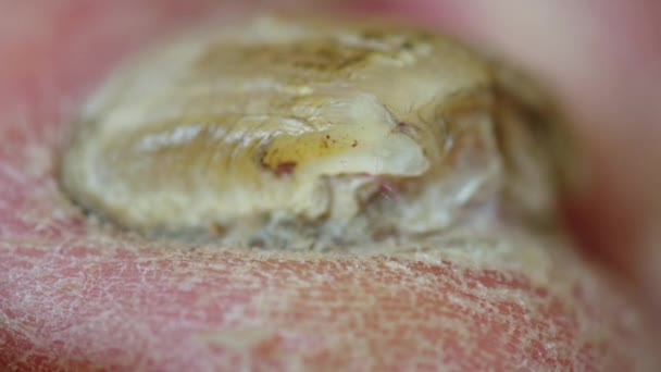 Malattia della pelle, Primo piano del fungo delle unghie, fungo delle dita dei piedi. — Video Stock