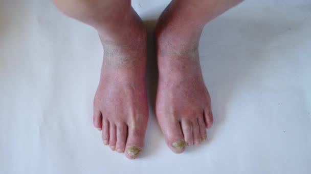 Närbild av en fot med skadade naglar på grund av svamp. Äldre mäns ben. — Stockvideo