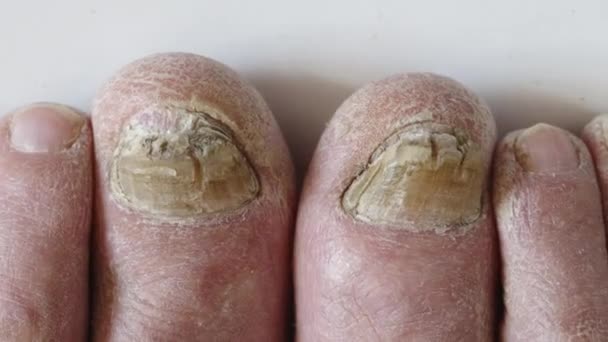 Nahaufnahme eines Fußes mit beschädigten Nägeln aufgrund eines Pilzes. Beine eines älteren Mannes. — Stockvideo