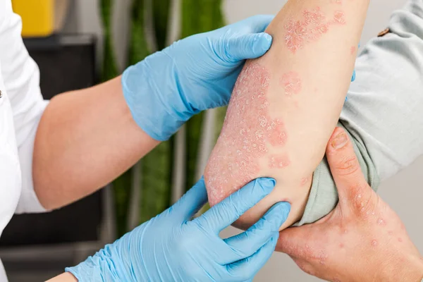 Eldiven takan bir dermatolog hasta bir hastanın derisini inceliyor. Deri hastalıklarının incelenmesi ve teşhisi alerji, sedef, egzama, deri iltihabı..