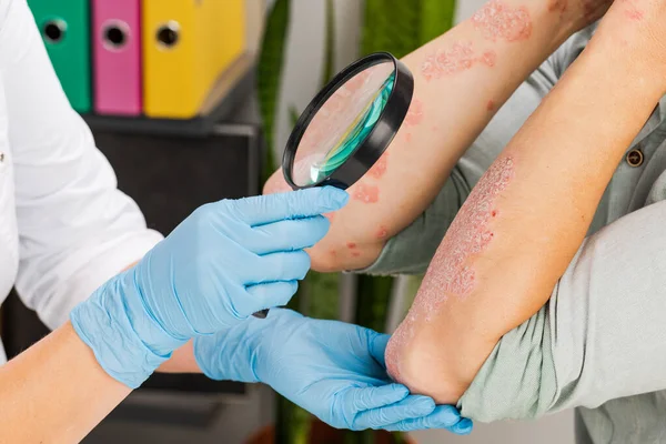 一位戴手套的皮肤科医生检查病人的皮肤 皮肤病 银屑病 皮炎的检查和诊断 — 图库照片