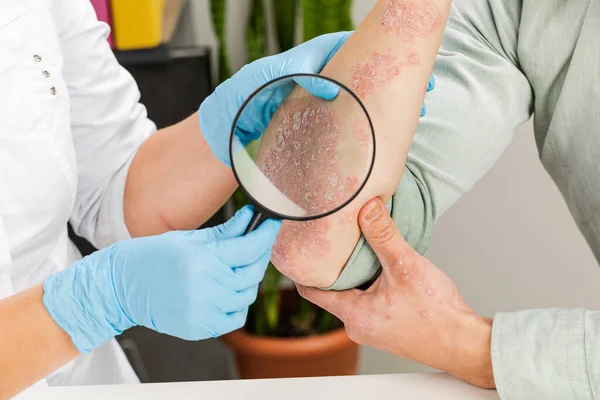 Eldiven takan bir dermatolog hasta bir hastanın derisini inceliyor. Deri hastalıklarının incelenmesi ve teşhisi alerji, sedef, egzama, deri iltihabı..