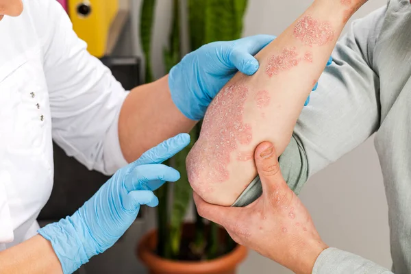 Eldiven takan bir dermatolog hasta bir hastanın derisini inceliyor. Deri hastalıklarının incelenmesi ve teşhisi alerji, sedef, egzama, deri iltihabı..