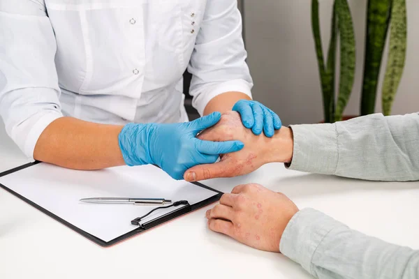 Eldiven takan bir dermatolog hasta bir hastanın derisini inceliyor. Deri hastalıklarının incelenmesi ve teşhisi alerji, sedef, egzama, deri iltihabı..
