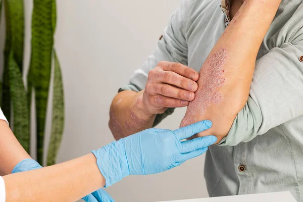 一位戴手套的皮肤科医生检查病人的皮肤 皮肤病 银屑病 皮炎的检查和诊断 — 图库照片