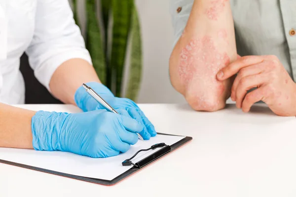 一位戴手套的皮肤科医生检查了一位病人的皮肤 并记录了观察结果 皮肤病 银屑病 皮炎的检查和诊断 — 图库照片
