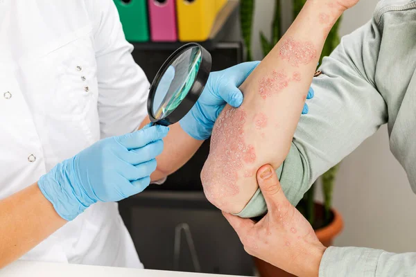 A dermatologist wearing gloves examines the skin of a sick patient. Examination and diagnosis of skin diseases-allergies, psoriasis, eczema, dermatitis.