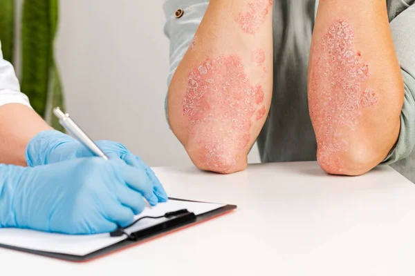 Eldivenli bir dermatolog hasta bir hastanın derisini inceliyor ve gözlemleri kaydediyor. Deri hastalıklarının incelenmesi ve teşhisi alerji, sedef, egzama, deri iltihabı..