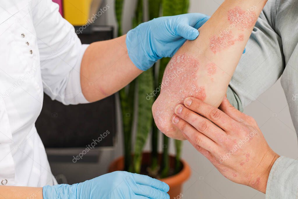 A dermatologist wearing gloves examines the skin of a sick patient. Examination and diagnosis of skin diseases-allergies, psoriasis, eczema, dermatitis.