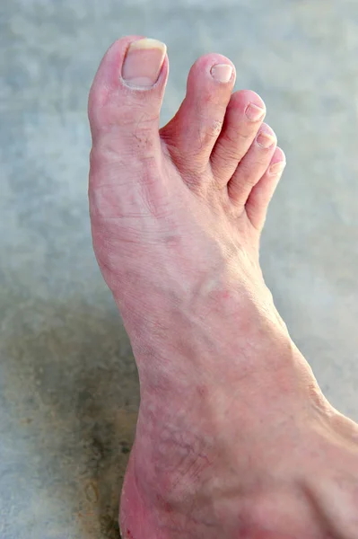 Close Asian Man Foot Dry Skin Toenail Fungus Health Concept — Stock Photo, Image
