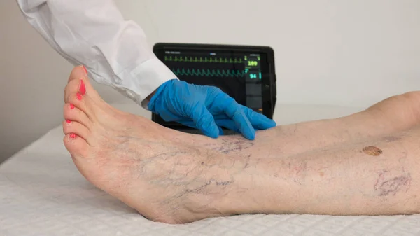Elderly patient at the doctor who checks her legs with many varicose veins Stock Picture