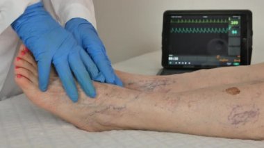 elderly patient at the doctor who checks her legs with many varicose veins