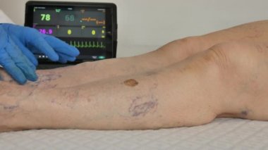 elderly patient at the doctor who checks her legs with many varicose veins