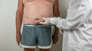 surgeon doing a medical checkup by palpating the belly on adipose tissues, cellulite, on a man patient with a flacid belly, seen from the front