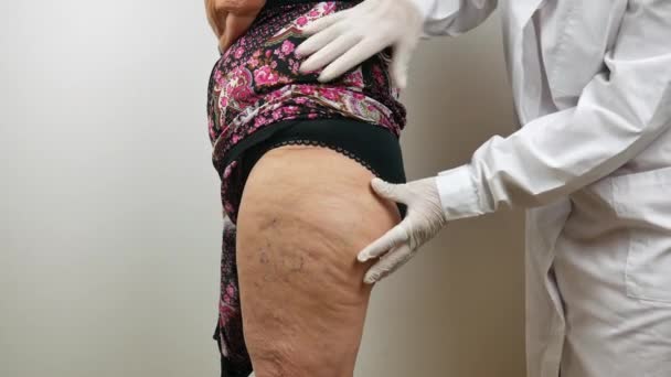 Chirurg bei einem medizinischen Check durch Abtasten des Gesäßes, an Fettgewebe, Cellulite, an einer Patientin mit, vom Seitenprofil aus gesehen — Stockvideo