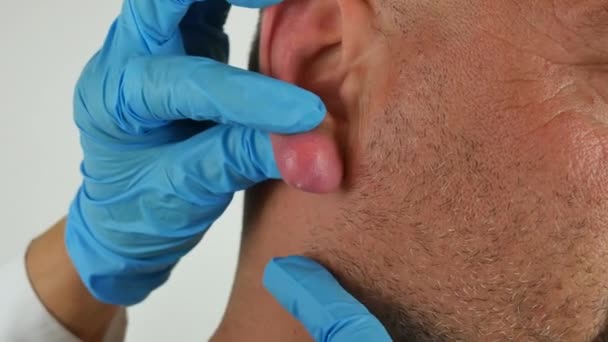 Médecin avec des gants bleus examinant un abcès avec du pus sur une oreille enflée et enflammée d'un homme caucasien — Video