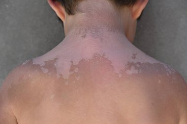 Bir çocukta Vitiligo deri hastalığı