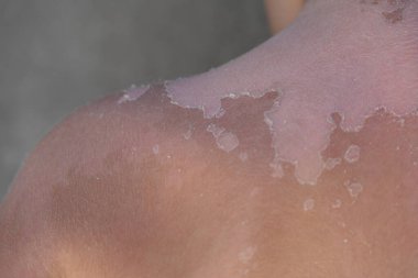 Bir çocukta Vitiligo deri hastalığı