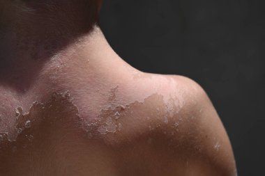 Bir çocukta Vitiligo deri hastalığı