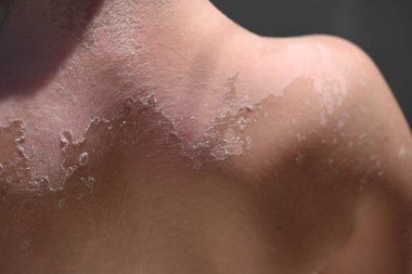 Bir çocukta Vitiligo deri hastalığı