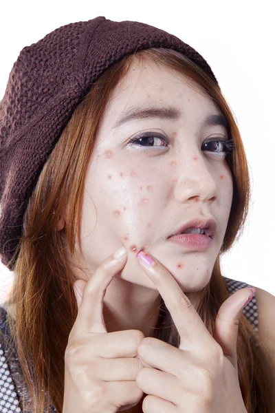 Teen girl pressing her pimple — Stock Photo, Image