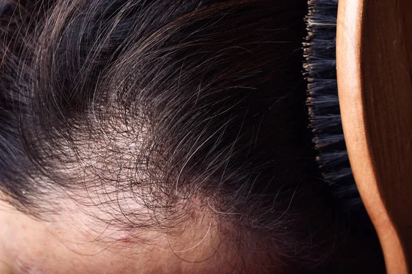 Problemi Salute Dei Capelli Del Cuoio Capelluto Giovane Donna Asiatica — Foto Stock