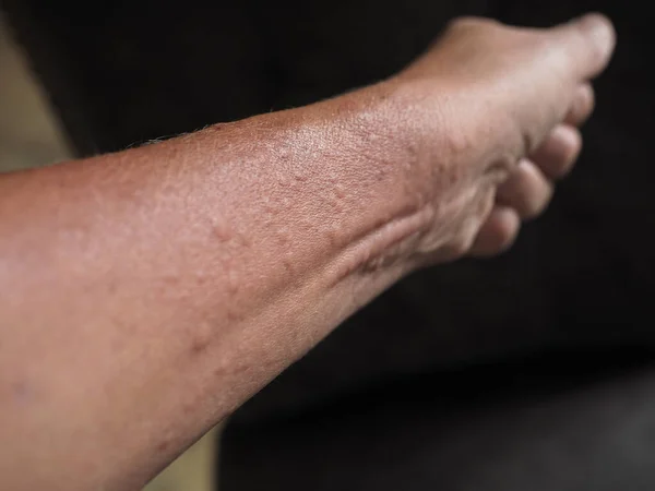 Symptoms of contact allergy on hand skin. Close up of hives.