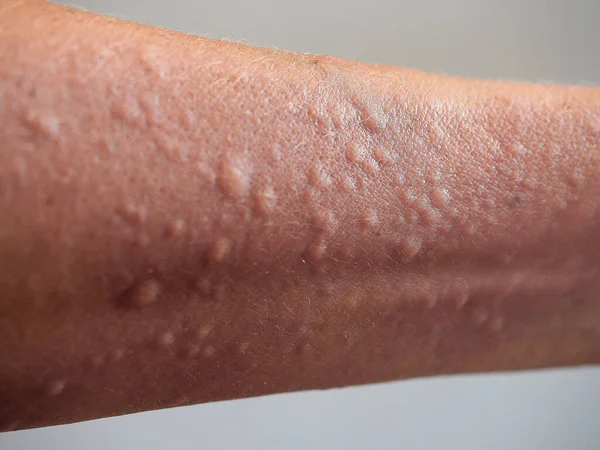 Συμπτώματα Αλλεργίας Επαφής Στο Δέρμα Του Χεριού Κλείσιμο Κυψελών — Φωτογραφία Αρχείου