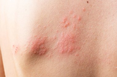 Deri enfeksiyon kapmış Herpes zoster virüsü. Vücudunda uçuk virüsü var. ürtiker döküntüsü. Vücutta atopik dermatit.