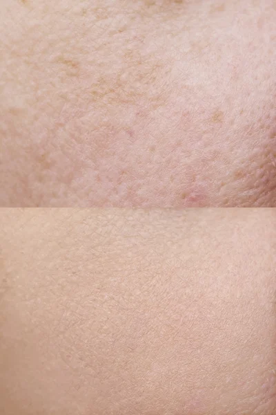 Pele antes e depois do tratamento — Fotografia de Stock