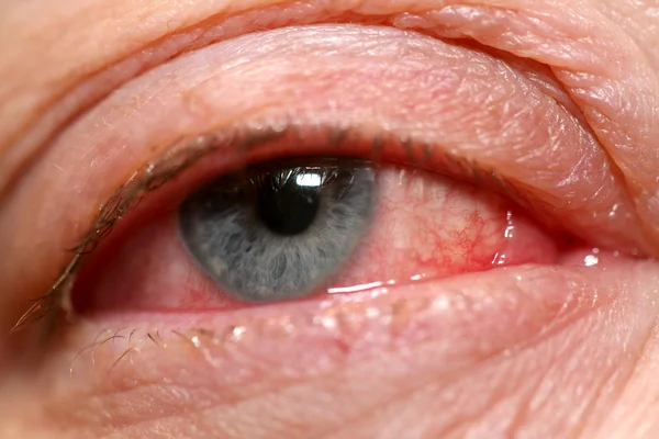 Olho humano com conjuntivite — Fotografia de Stock