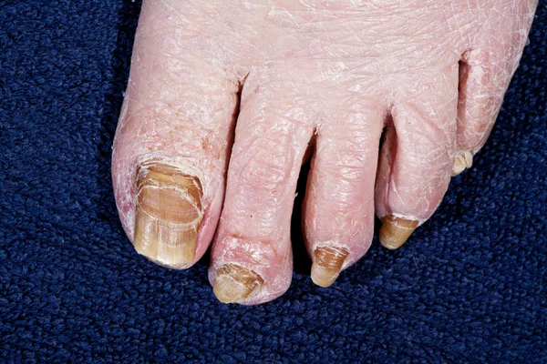 Pregos pés pessoa afetada pelo fungo — Fotografia de Stock