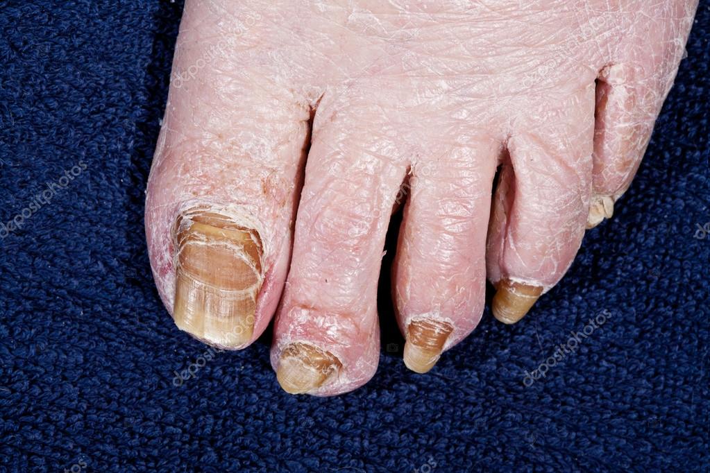 nail gombák eltávolító nail on leg szoptató anya kezelheti-e a körömgombát