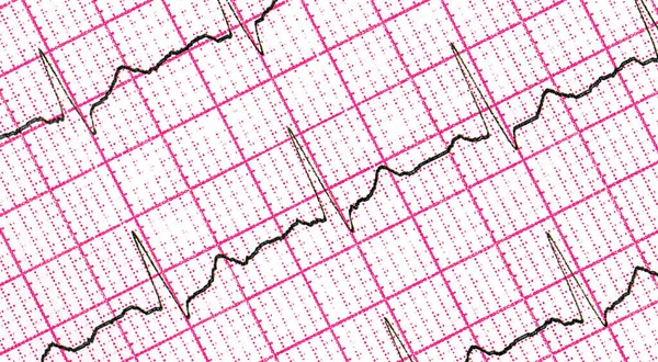 Kardiogram Fragment Medicinska Forskningsresultat Abstrakt Bakgrund — Stockfoto