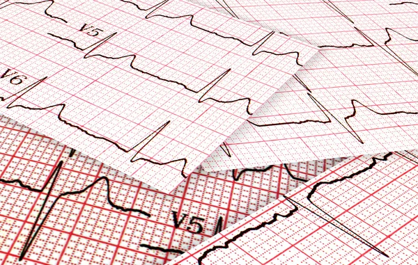 Grafici dei cardiogrammi — Foto Stock