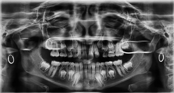 Dientes radiográficos —  Fotos de Stock