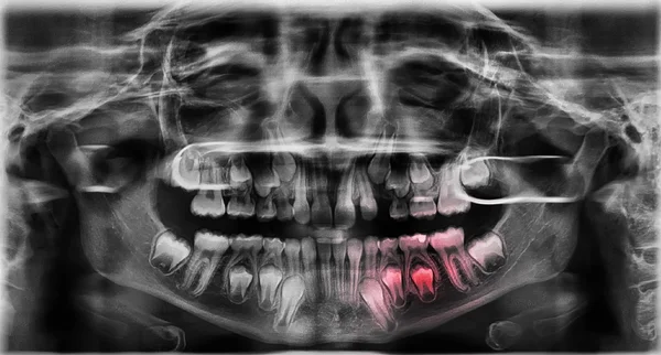 Зубы радиографии — стоковое фото